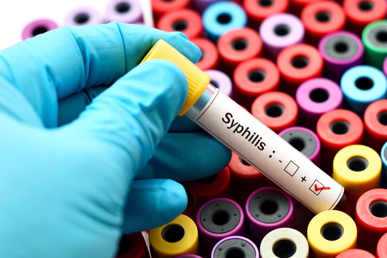Getting Diagnosed with Syphilis