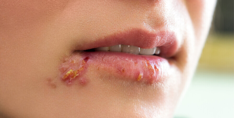 Understanding Herpes