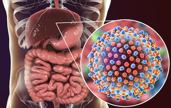 Hepatitis C infection. Computer illustration showing liver and close-up view of hepatitis C viruses.