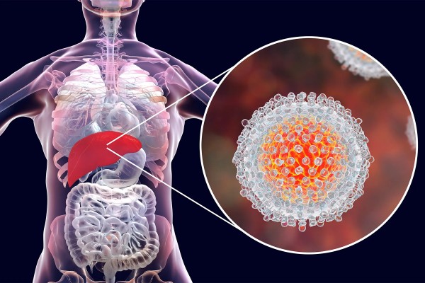 hepatitis C